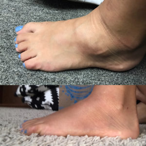 cryotherapy-for-post-injury-recovery